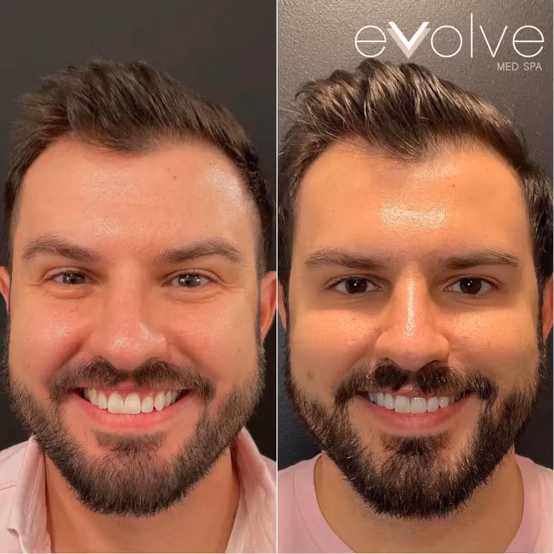 Before and after treatment results at MDW Aesthetics Miami in Brickell