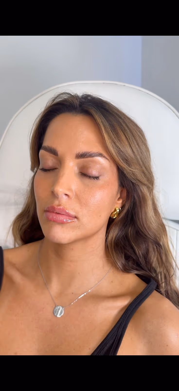 PRP Smile Lines at MDW Aesthetics Miami